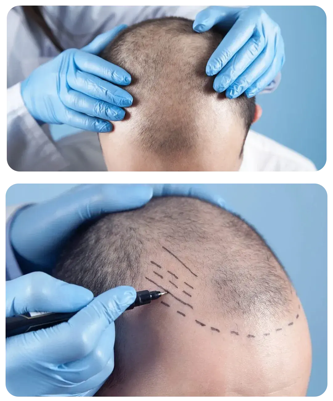 Clínica Jacobovski - Clínica capilar Barcelona Clínica Jacobovski - Clínica capilar Barcelona