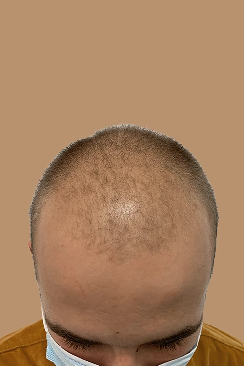 mesoterapia-01-antes