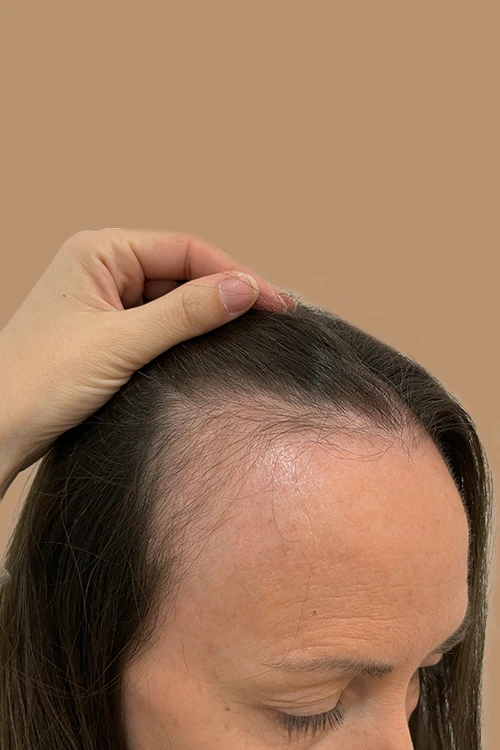 mesoterapia-02-antes