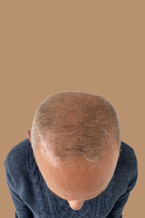 mesoterapia-03-antes