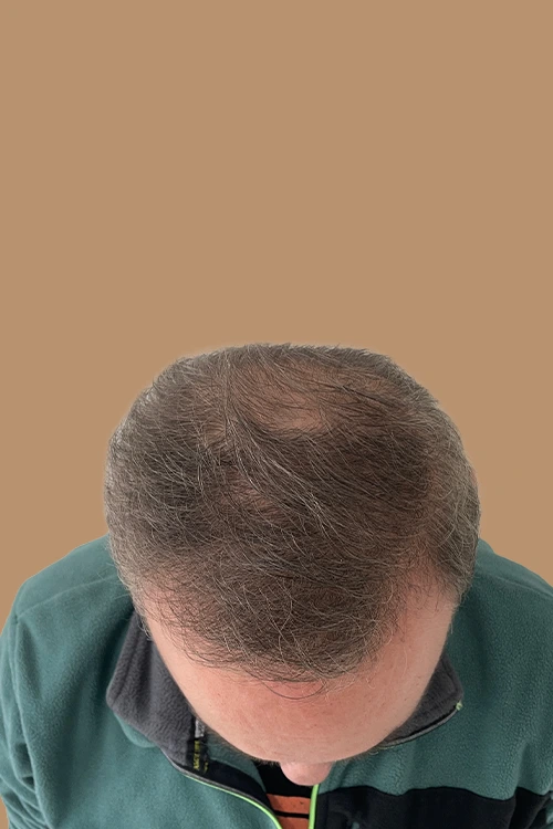 mesoterapia-03-despues